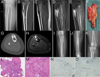 Osteofibrous dysplasia-like adamantinoma: A case report and literature review